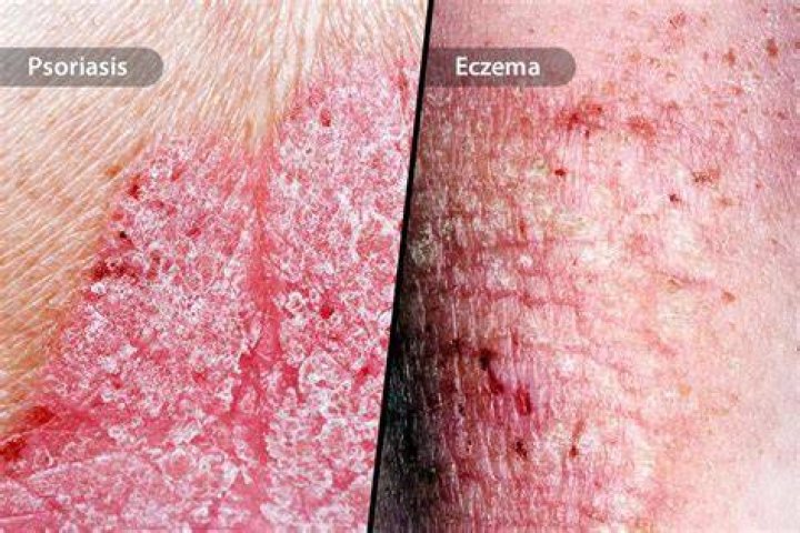 How can you tell the difference between Paget's disease and eczema?