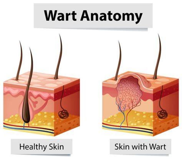 How deep can a wart grow?