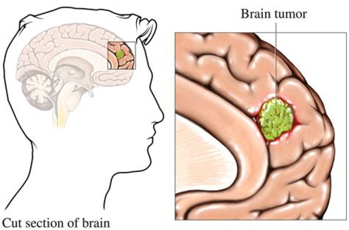 How do I find my brain tumor?