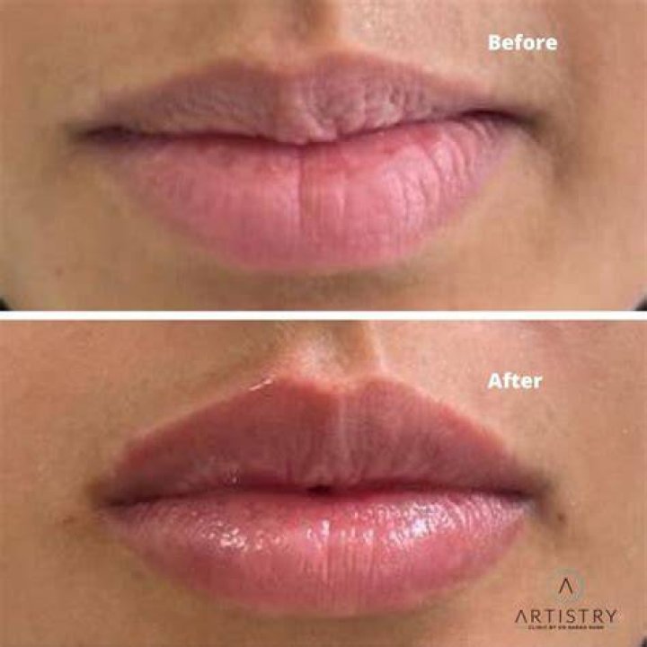 How do I get rid of a fat lip?