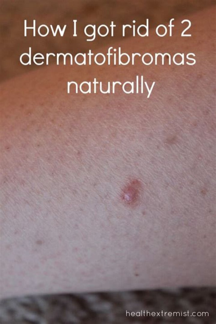 How do I get rid of dermatofibroma?