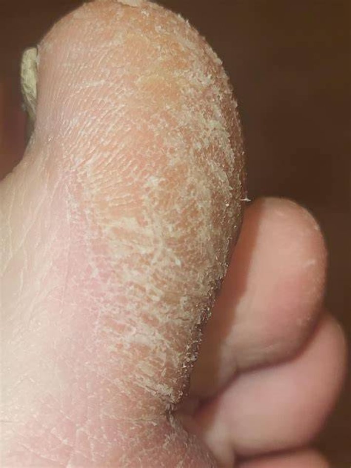 How do I get rid of the crust between my toes?