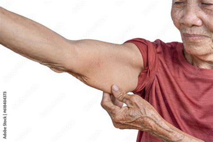 How do I get rid of wrinkles on my upper arms?