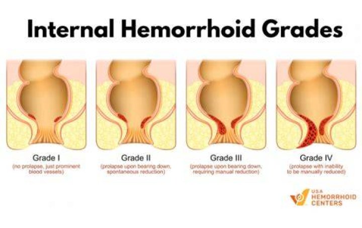 How do I know if I have internal hemorrhoids?