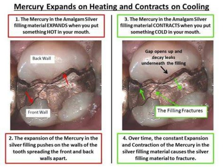 How do I know if I have mercury in my fillings?