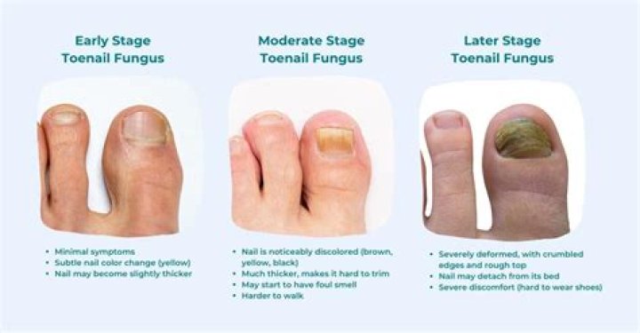 How do I know if my toenail has fungus?