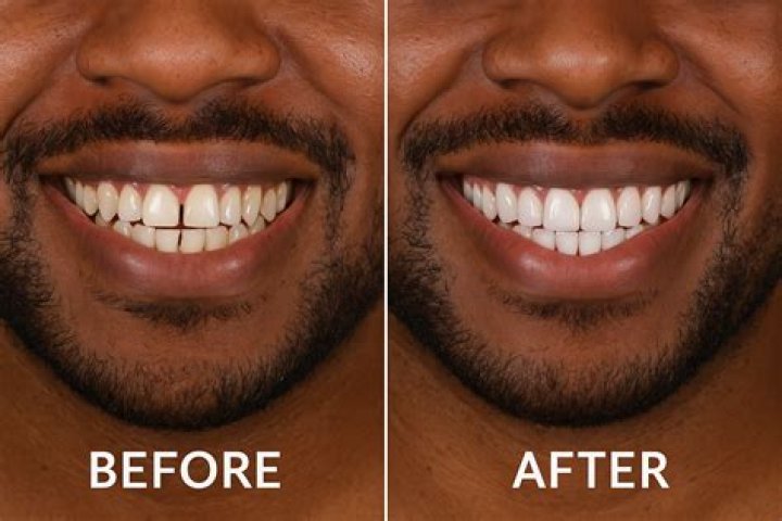 How do I make my composite veneers white again?
