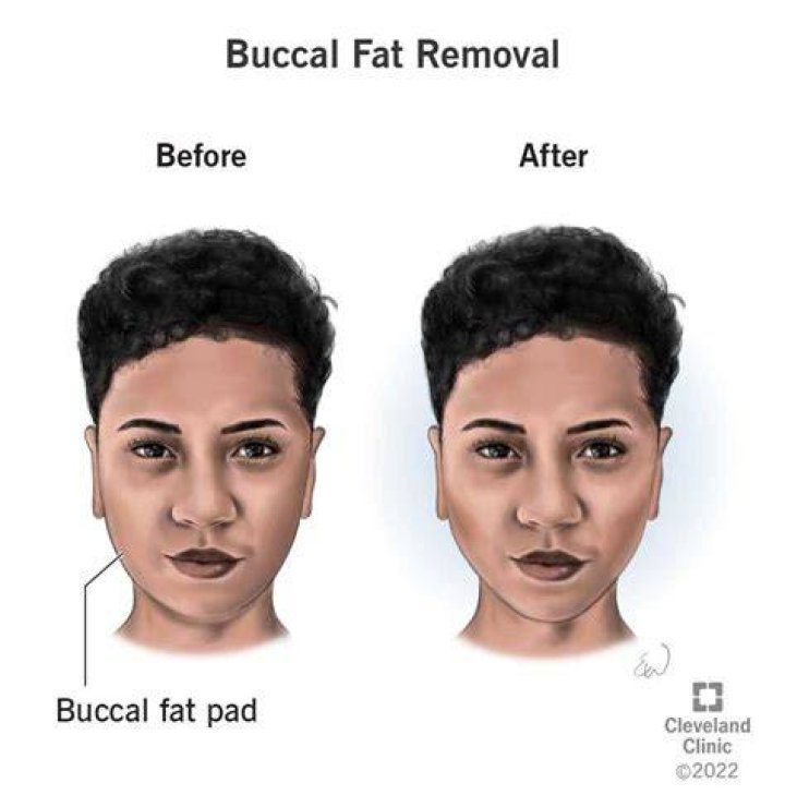 How do I not get fat after surgery?