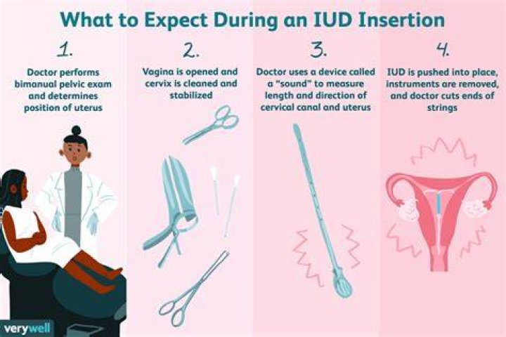 How do I prepare for an IUD?