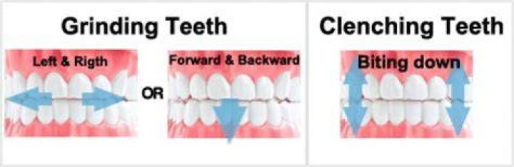 How do I stop grinding my teeth and clenching?