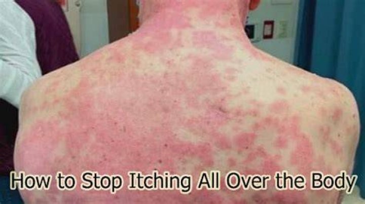 How do I stop uncontrollable itching all over my body?
