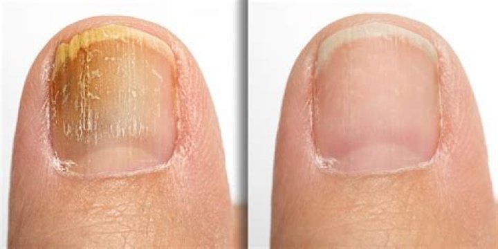 How do podiatrist treat toenail fungus?