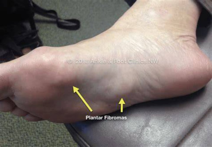 How do you break up a plantar fibroma?
