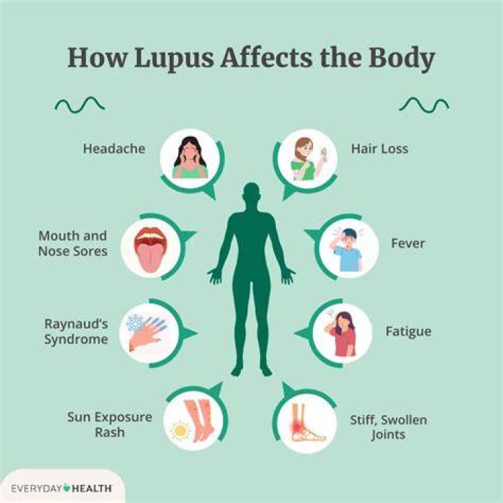 How do you challenge lupus?