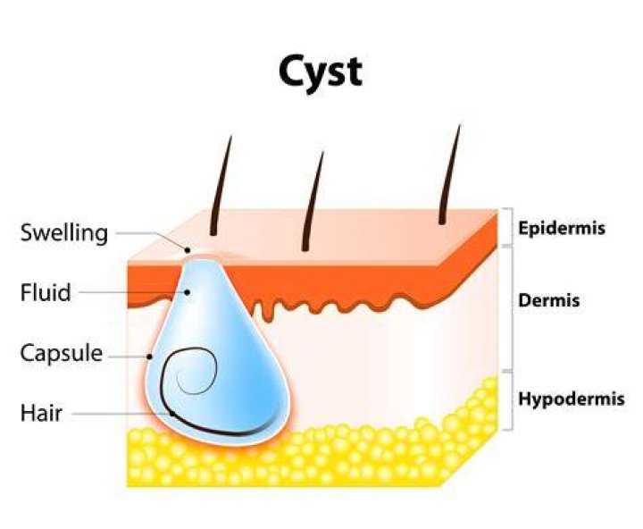How do you draw out a cyst?