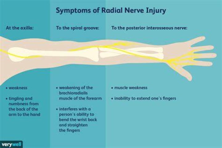 How do you fix radial nerve damage?