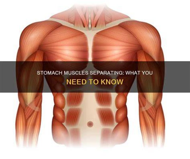 How do you fix separated stomach muscles?