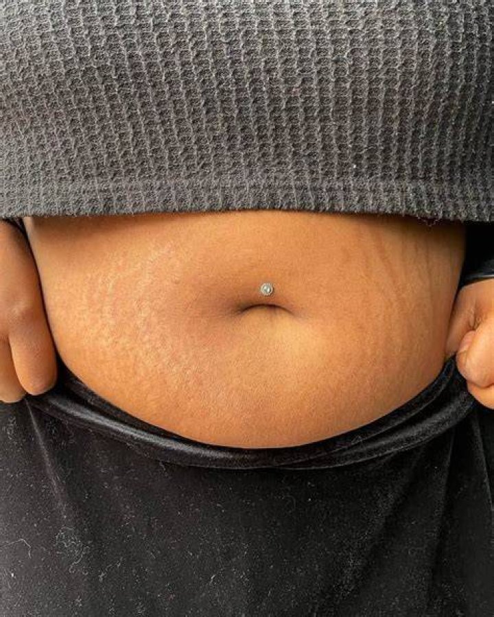 How do you get rid of a black belly button stone?