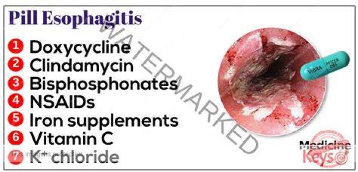 How do you get rid of pill-induced esophagitis?