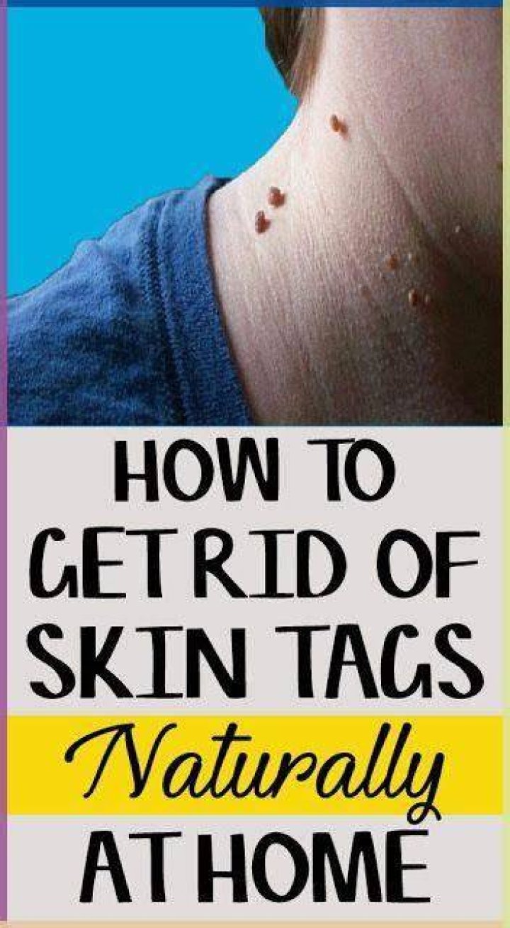 How do you get rid of skin tags and warts naturally?