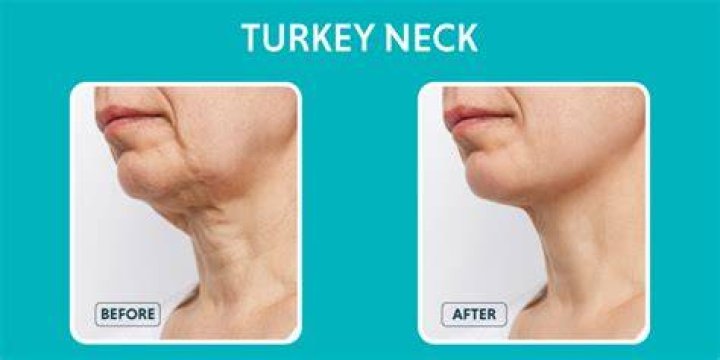 How do you get rid of turkey neck?