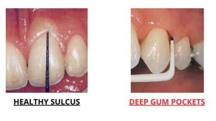 How do you heal a deep pocket in your gums?