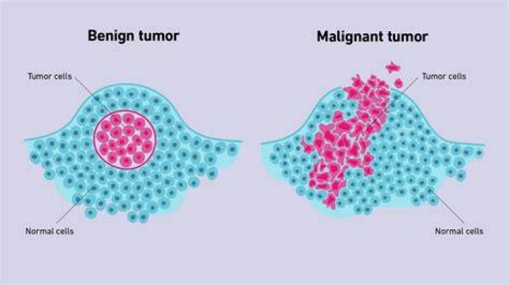 How do you identify a tumor?