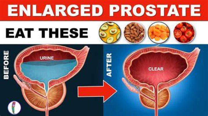 How do you keep your prostate from enlarging?
