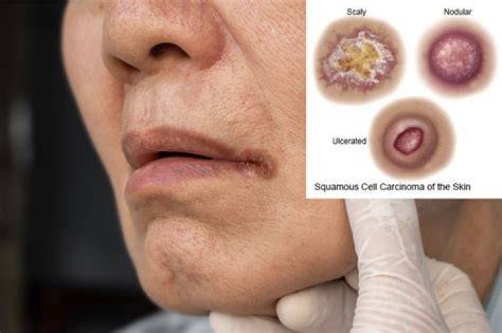 How do you know if squamous cell has metastasized?