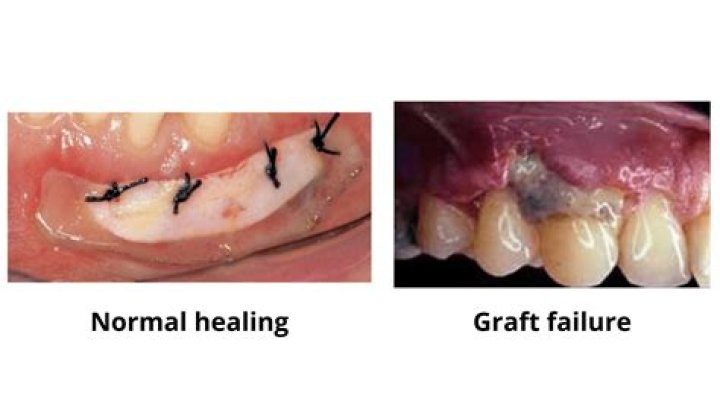 How do you know if you have an infection after gum graft?