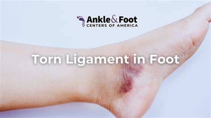 How do you know if you tore a ligament in your toe?