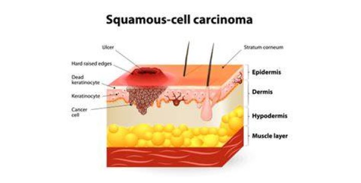 How do you know if your squamous cell carcinoma has spread?