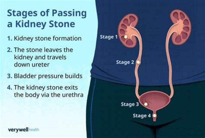 How do you know when a kidney stone is close to passing?
