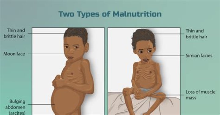 How do you manage dehydration in malnutrition?