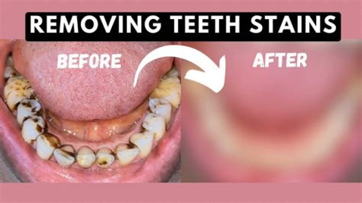 How do you remove stains from composite teeth?