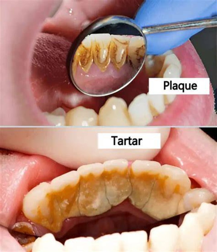 How do you remove tartar with a pick?