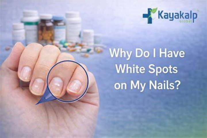 How do you Repigment white spots?