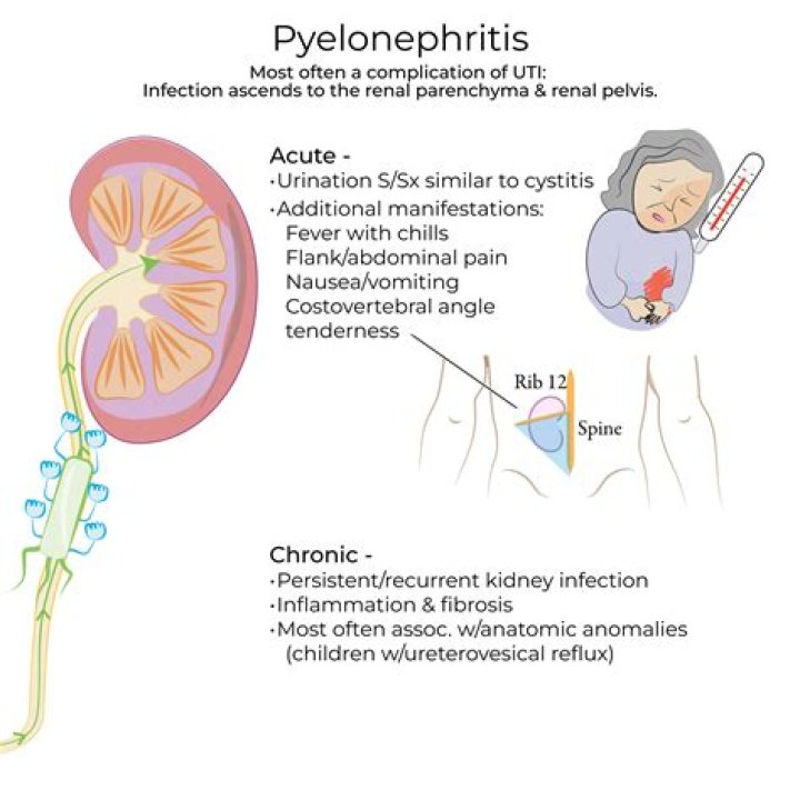 How do you rule out pyelonephritis?