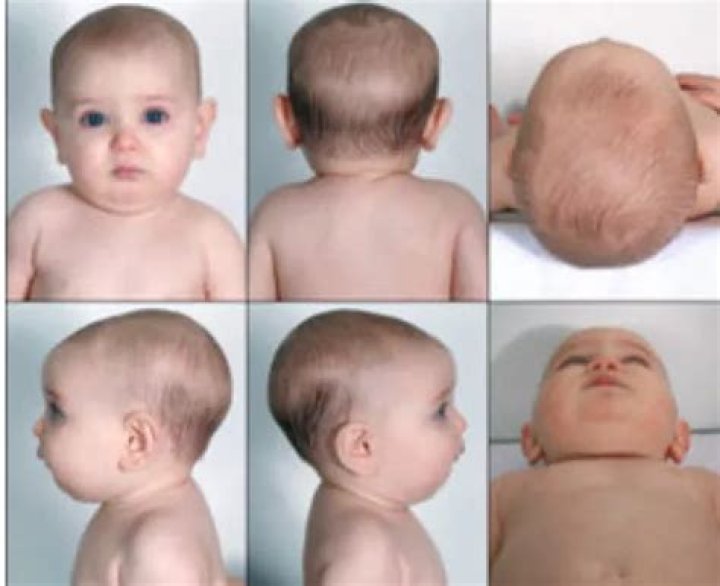 How do you shape a baby's head?