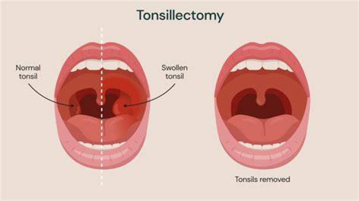 How do you swallow after a tonsillectomy?