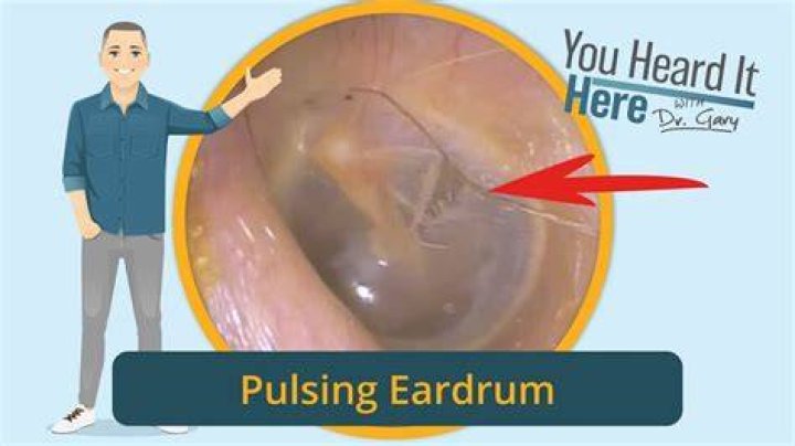 How do you treat a pulsating ear?