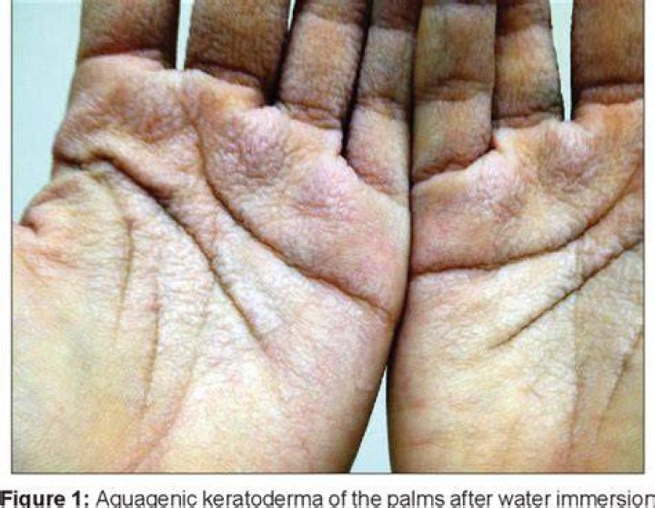 How do you treat aquagenic keratoderma?