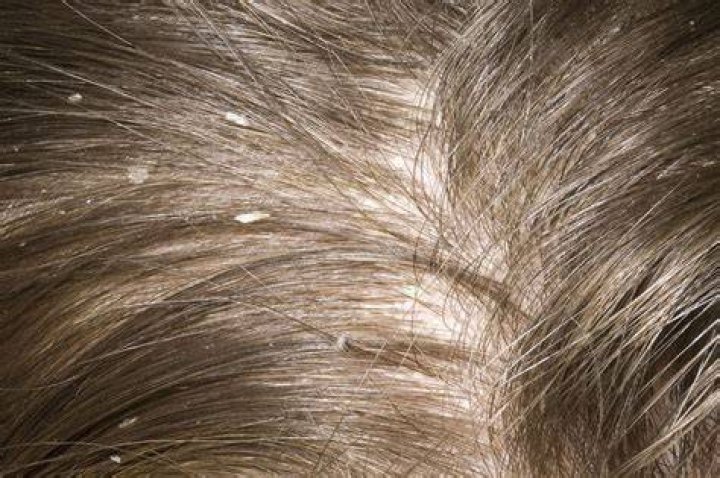 How do you treat yellow dandruff?