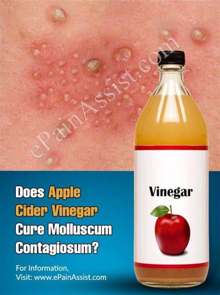 How does apple cider vinegar cure trichomoniasis?