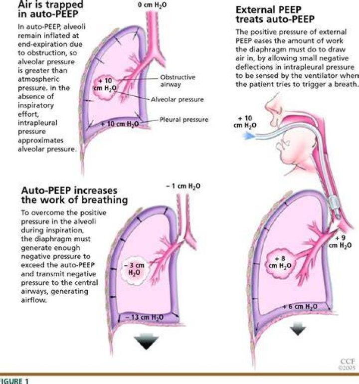 How does PEEP affect BP?