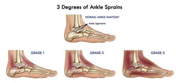 How is a third degree sprain treated?