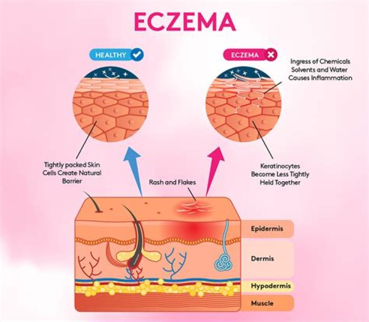 How is eczema spread?
