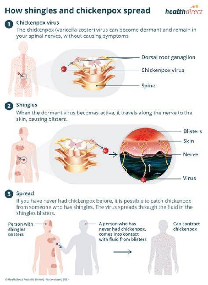 How is shingles spread airborne?