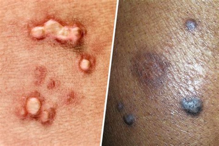 How long are you contagious with HPV?