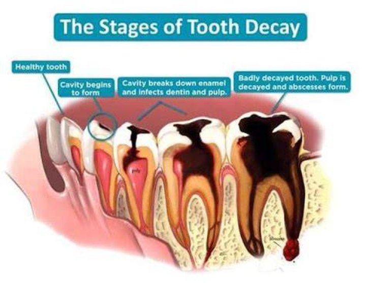 How long can a decayed tooth last?